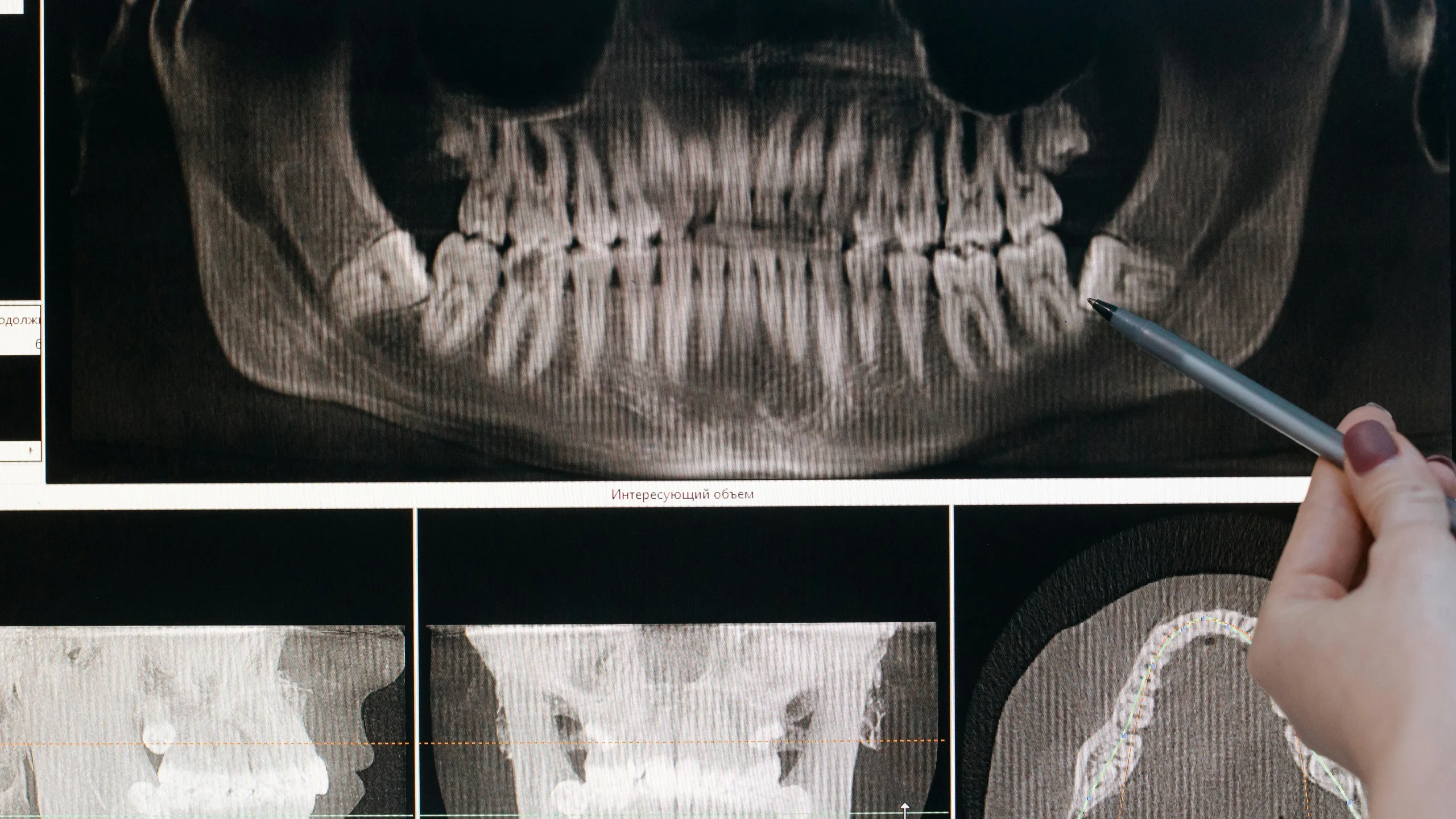 Obedoza Dental X-Ray