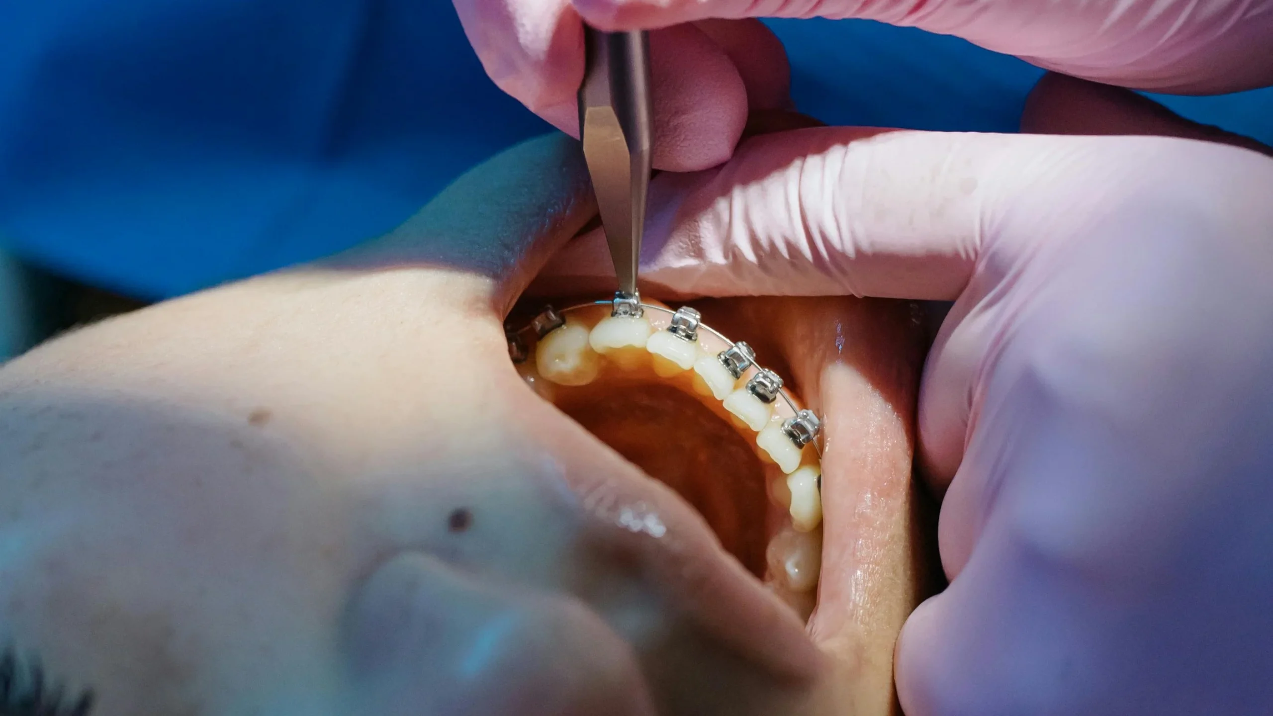 Obedoza Dental Restoration Service Obedoza Dental Restoration