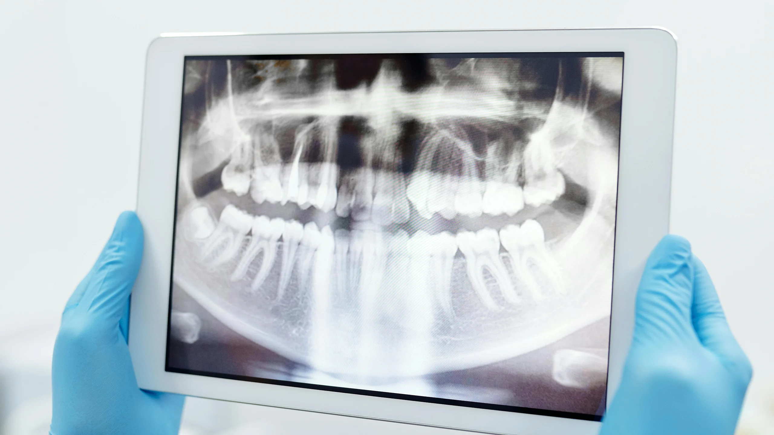 Are Dental X-Rays Safe? Addressing Common Concerns About Radiation Exposure