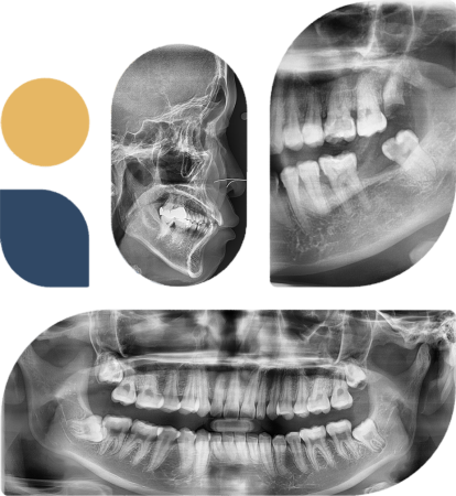 X-Rays Results at Obedoza Dental Center & Associates